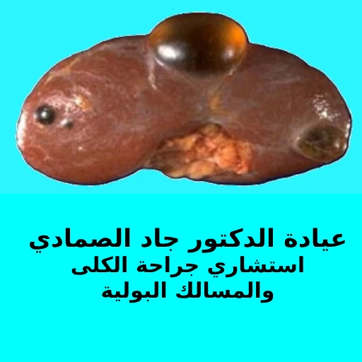 An informative diagram of a kidney cyst as explained by Dr. Jad Alsmadi تعرف على المزيد عن تكيس الكلية مع الدكتور جاد الصمادي